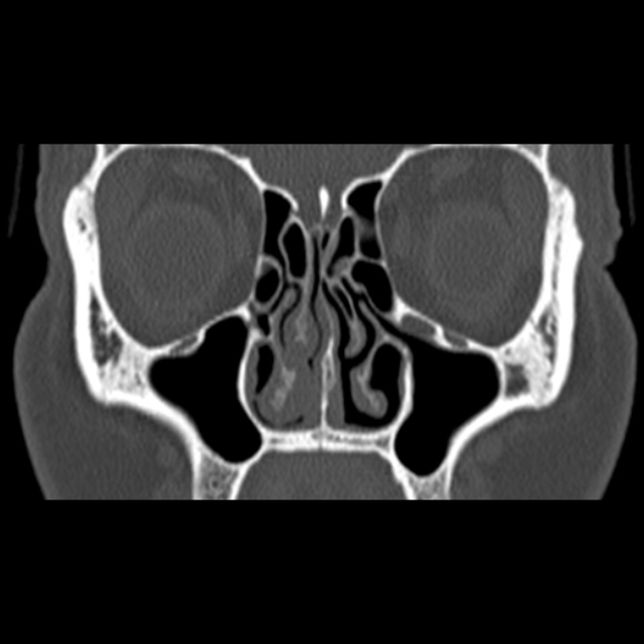 Nasal septal perforation (Radiopaedia 25030-25289 Coronal bone window 29).jpg
