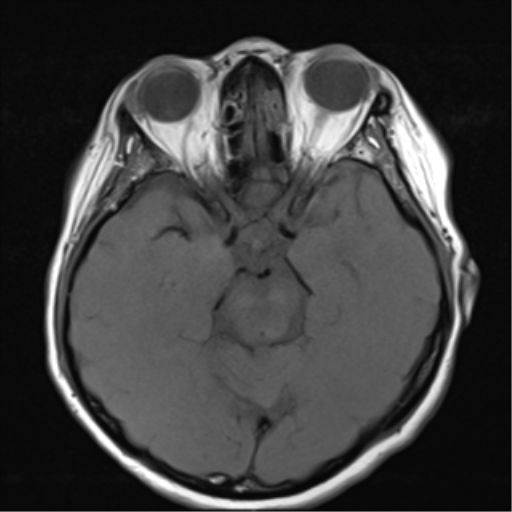 File:Nasopharyngeal carcinoma with cerebral abscess (Radiopaedia 43018-46273 Axial T1 10).png