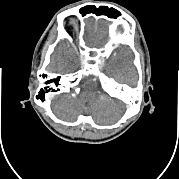 Nasopharyngeal carcinoma with skull base invasion (Radiopaedia 53415-59705 A 10).jpg