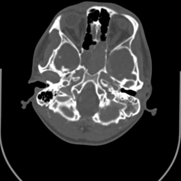Nasopharyngeal carcinoma with skull base invasion (Radiopaedia 53415-59705 Axial bone window 19).jpg