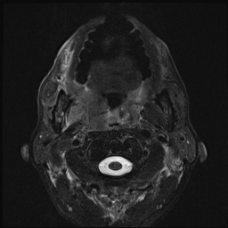 File:Nasopharyngeal carcinoma with skull base invasion (Radiopaedia 59258-66600 D 30).jpg