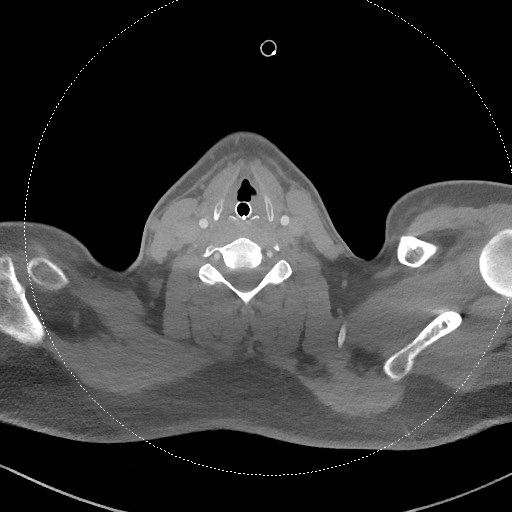 Neck CT angiogram (intraosseous vascular access) (Radiopaedia 55481-61945 B 157).jpg