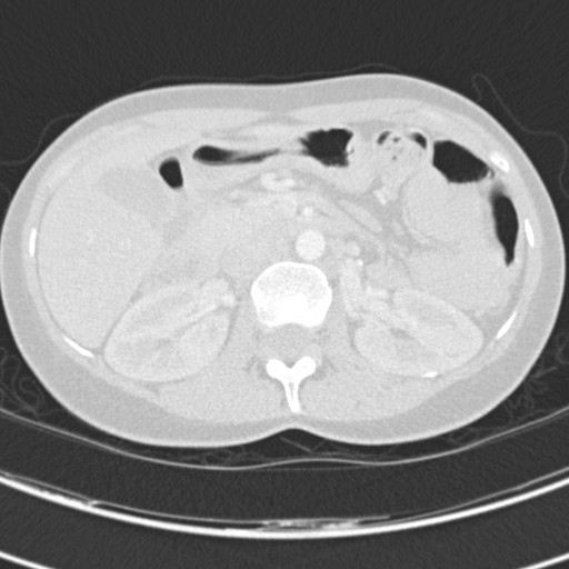 Necrobiotic pulmonary nodules - Crohn disease (Radiopaedia 20723-20631 Axial lung window 158).jpg