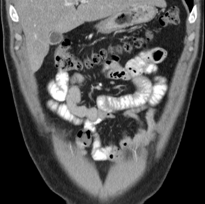 File:Necrotizing pancreatitis with acute necrotic collection (Radiopaedia 14470-14417 C 5).jpg