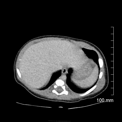 File:Neonatal neuroblastoma (Radiopaedia 56651-63438 Axial non-contrast 16).jpg