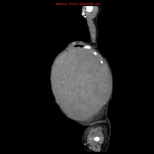 File:Neonatal neuroblastoma (Radiopaedia 9564-10223 C 19).jpg