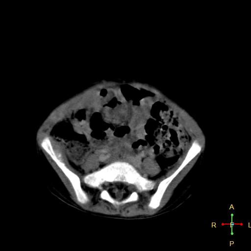 File:Neuroblastoma (Radiopaedia 24751-25016 D 30).jpg