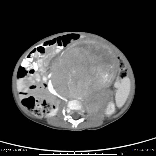 File:Neuroblastoma (Radiopaedia 41472-44355 A 24).jpg