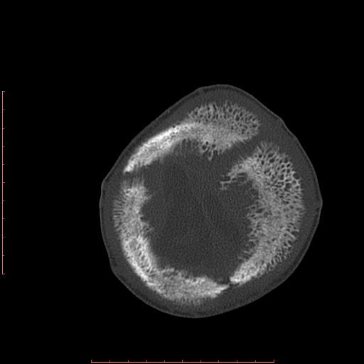 File:Neuroblastoma skull metastasis (Radiopaedia 56053-62683 Axial bone window 24).jpg