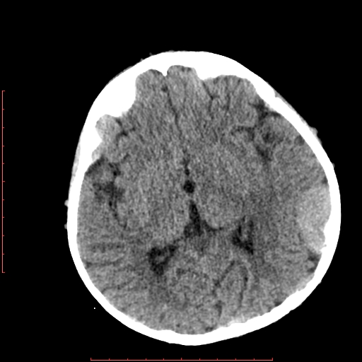 File:Neuroblastoma skull metastasis (Radiopaedia 56053-62683 Axial non-contrast 9).jpg