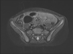 File:Neuroblastoma with bone metastases (Radiopaedia 67080-76414 Axial STIR 59).jpg
