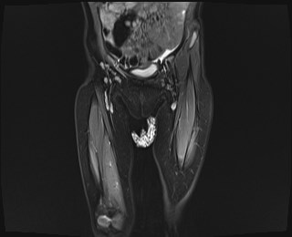 File:Neuroblastoma with bone metastases (Radiopaedia 67080-76414 Coronal STIR 5).jpg
