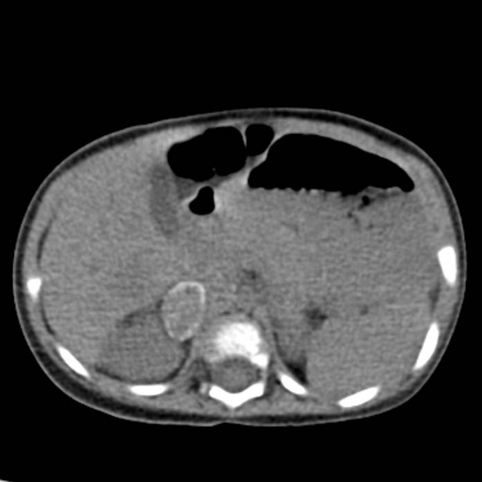 Neuroblastoma with skull metastases (Radiopaedia 30326-30960 Axial non-contrast 19).jpg