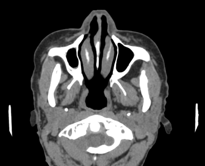 Neurofibromatosis type 1- orbital manifestations (Radiopaedia 49391-54511 Axial non-contrast 18).jpg