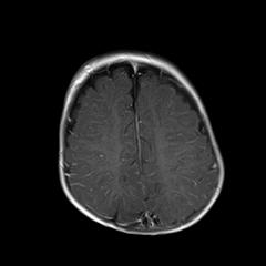 File:Neurofibromatosis type 1 (Radiopaedia 30089-30671 Axial T1 C+ 18).jpg