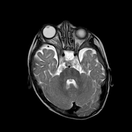File:Neurofibromatosis type 1 (Radiopaedia 30089-30671 Axial T2 7).jpg