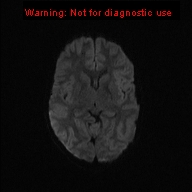 File:Neurofibromatosis type 1 with optic nerve glioma (Radiopaedia 16288-15965 Axial DWI 60).jpg