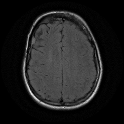 File:Neurofibromatosis type 2 (Radiopaedia 45229-49244 Axial FLAIR 15).png
