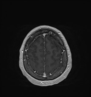 Neurofibromatosis type 2 (Radiopaedia 79097-92049 Axial T1 C+ 167).jpg