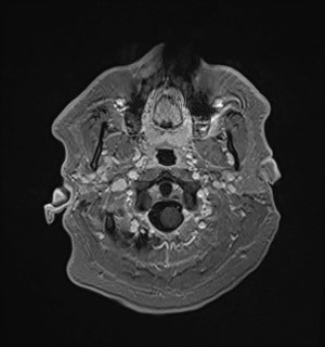 Neurofibromatosis type 2 (Radiopaedia 79097-92049 Axial T1 C+ 25).jpg