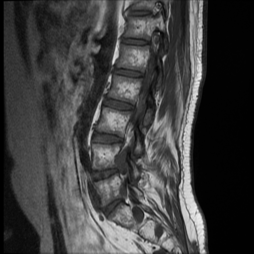 File:Neurofibromatosis type 2 (spinal manifestations) (Radiopaedia 53943-60070 F 5).png