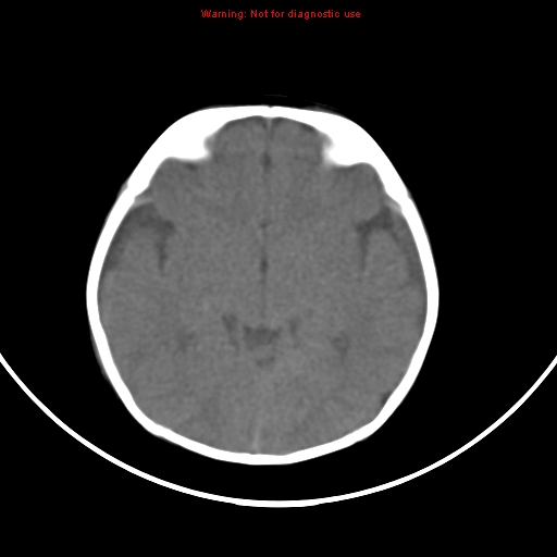 File:Non-accidental injury - bilateral subdural with acute blood (Radiopaedia 10236-10765 Axial non-contrast 10).jpg