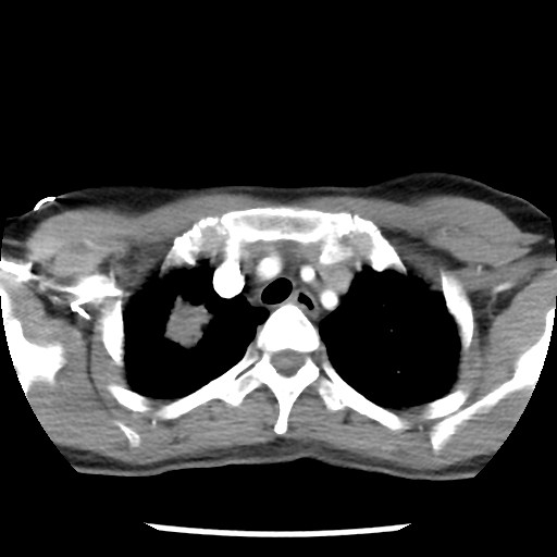 File:Non-small cell lung cancer with miliary metastases (Radiopaedia 23995-24193 A 12).jpg