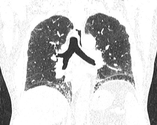 Non-specific interstitial pneumonia (NSIP) (Radiopaedia 68599-78228 Coronal lung window 56).jpg