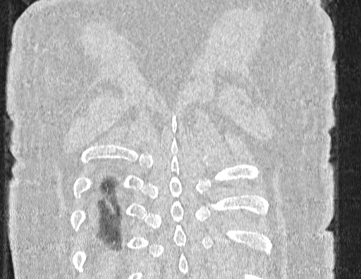 Non specific interstitial pneumonia (NSIP) (Radiopaedia 89725-106798 Coronal lung window 69).jpg