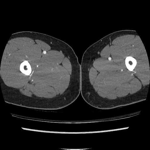 File:Normal CT angiogram of pelvis (Radiopaedia 45390-49430 A 80).jpg
