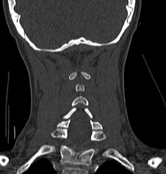 File:Normal CT cervical spine - 12-year-old (Radiopaedia 55352-61775 Coronal bone window 159).jpg
