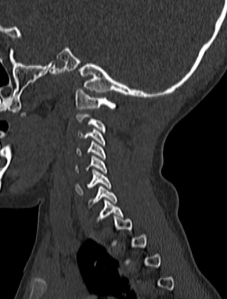 Normal CT cervical spine - pediatric (Radiopaedia 52549-58462 Sagittal bone window 39).jpg
