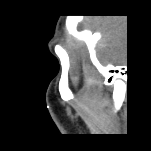 Normal CT paranasal sinuses (Radiopaedia 42286-45390 F 128).jpg