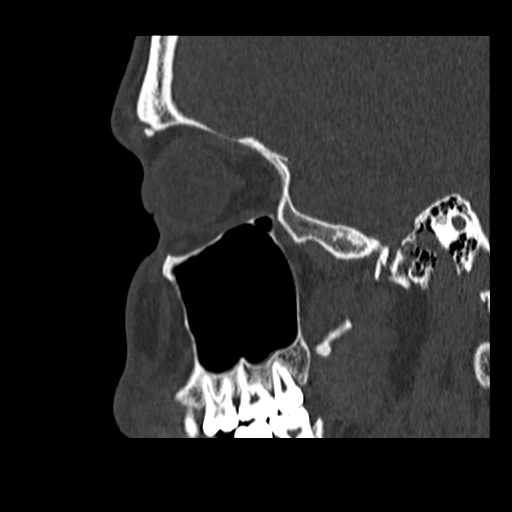 Normal CT paranasal sinuses (Radiopaedia 42286-45390 Sagittal bone window 78).jpg