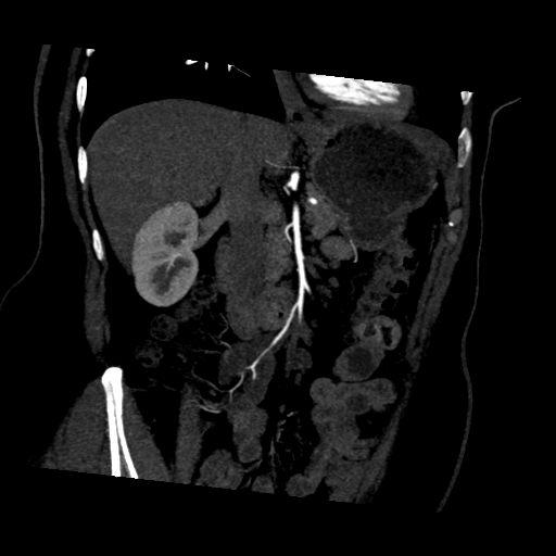 File:Normal CT renal artery angiogram (Radiopaedia 38727-40889 D 8).png