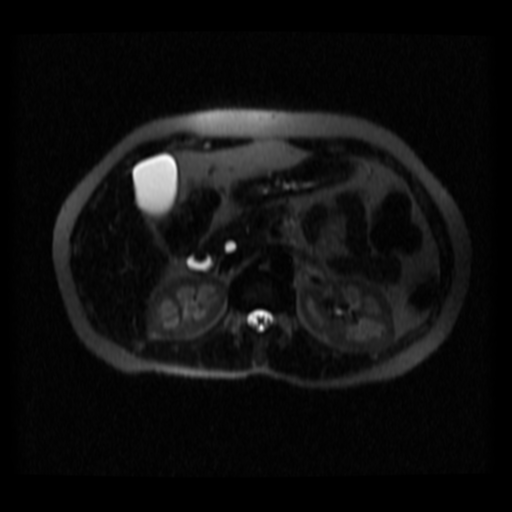 File:Normal MRCP (Radiopaedia 41966-44978 Axial T2 thins 15).png