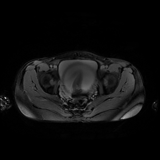 File:Normal MRI abdomen in pregnancy (Radiopaedia 88001-104541 D 50).jpg