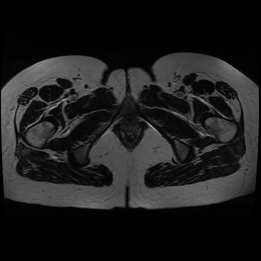 Normal MRI abdomen in pregnancy (Radiopaedia 88005-104548 Axial T2 49).jpg