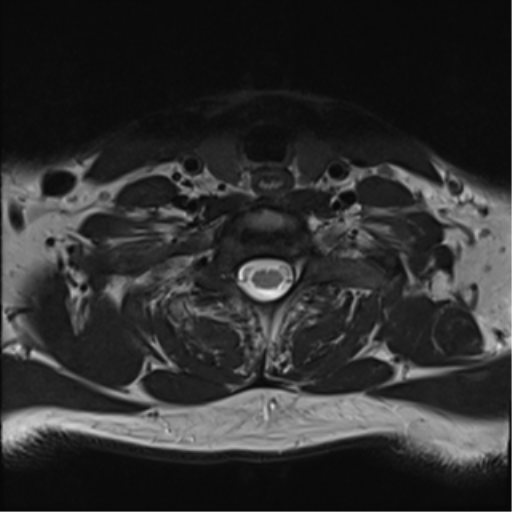 File:Normal MRI cervical spine (infection protocol) (Radiopaedia 53916-60039 Axial T2 40).png