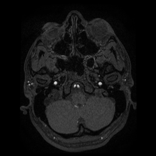 Normal brain MRA (Radiopaedia 41046-43793 Axial MRA 103).png