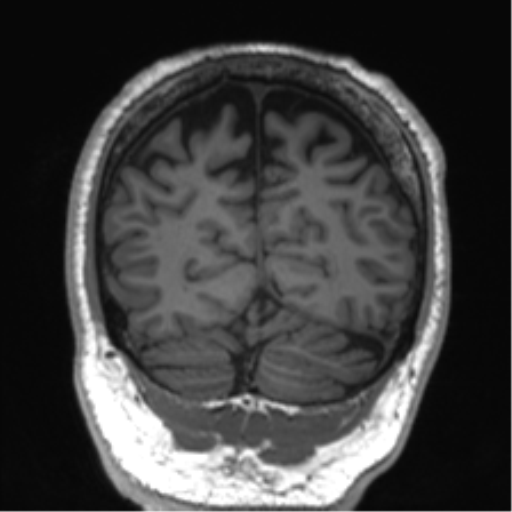 Normal brain MRI (non-focal epilepsy protocol) (Radiopaedia 53917-60040 Coronal T1 17).png