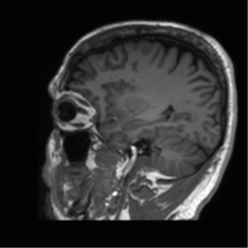 Normal brain MRI (non-focal epilepsy protocol) (Radiopaedia 53917-60040 Sagittal T1 18).png