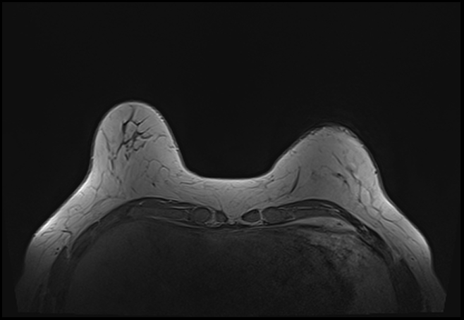 File:Normal breast MRI - dense breasts (Radiopaedia 80454-93850 Axial T1 44).jpg