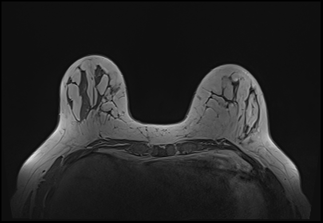 File:Normal breast MRI - dense breasts (Radiopaedia 80454-93850 Axial T1 66).jpg