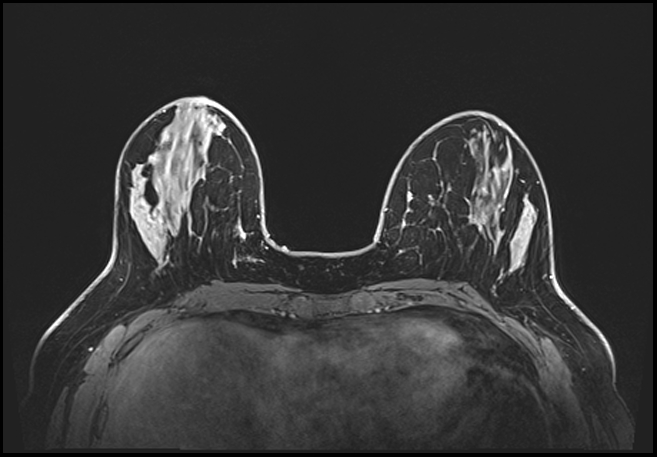 Normal breast MRI - dense breasts (Radiopaedia 80454-93850 C 76).jpg