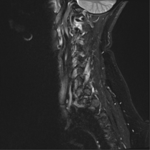 File:Normal cervical spine MRI (including Dixon) (Radiopaedia 42762-45925 Dixon- Water 1).png