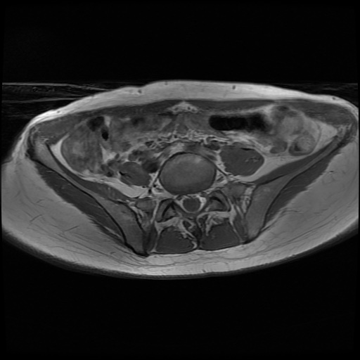 File:Normal female pelvis MRI (retroverted uterus) (Radiopaedia 61832-69933 Axial T1 5).jpg