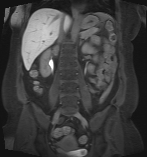 File:Normal hepatobiliary phase liver MRI (Radiopaedia 58968-66230 B 21).jpg