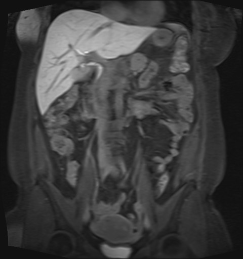 File:Normal hepatobiliary phase liver MRI (Radiopaedia 58968-66230 B 29).jpg
