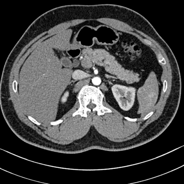 Normal kidneys on 4-phase CT study (Radiopaedia 25889-26038 B 14).jpg
